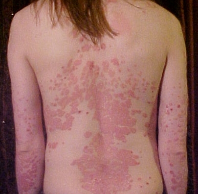 Homeopathic treatment for Psoriasis and scaly skin patches