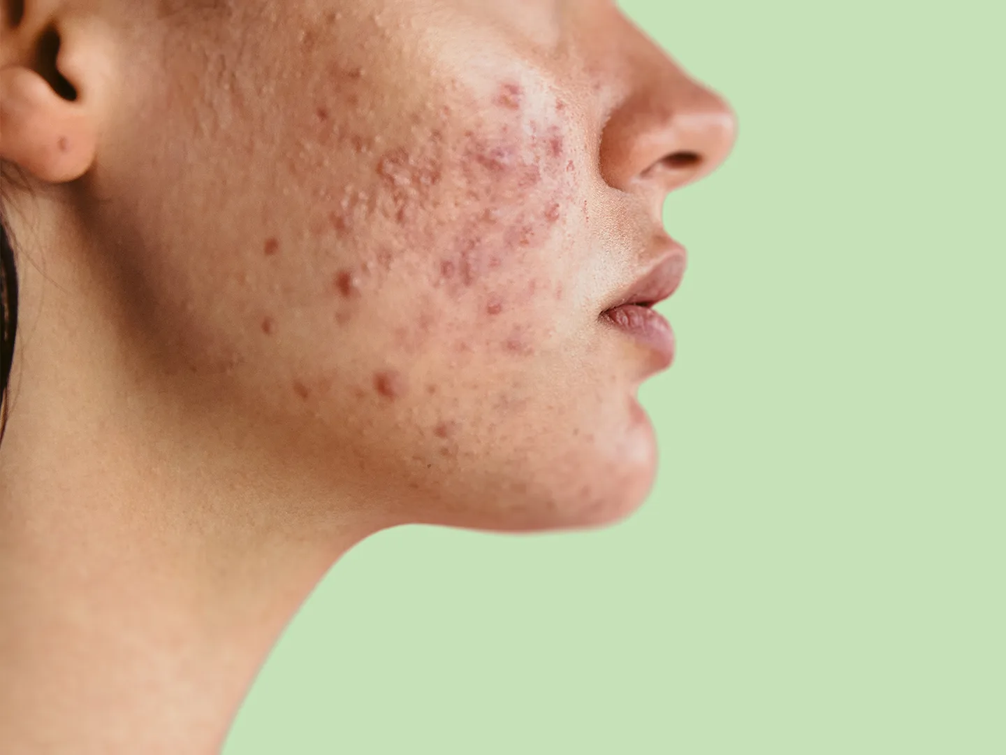 Homeopathic treatment for chronic Acne, pimples, and oily skin