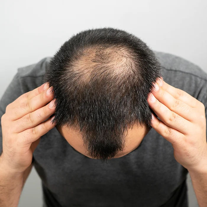 Hair Loss Treatment with Homeopathy in Gwalior