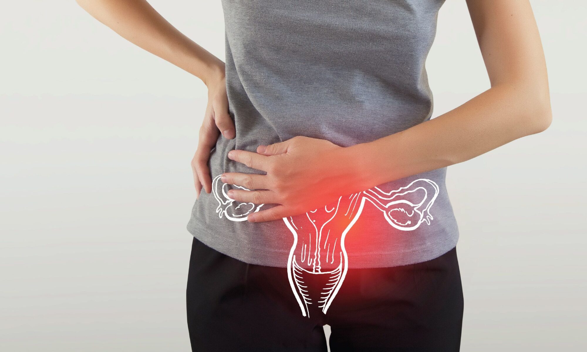 Homeopathic treatment for PCOS PCOD symptoms, including acne and weight gain