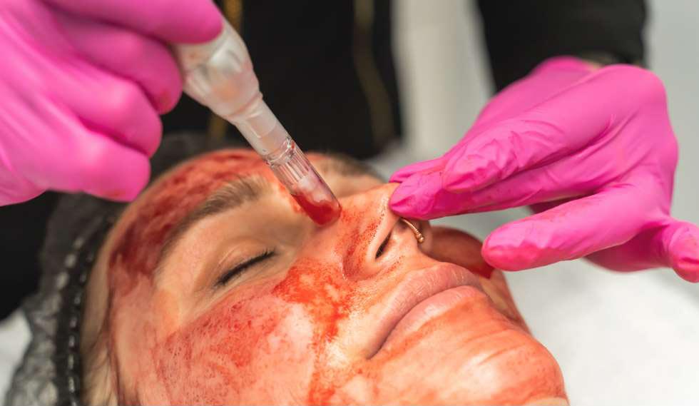 Vampire Facial PRP Treatment for Youthful Skin in Gwalior